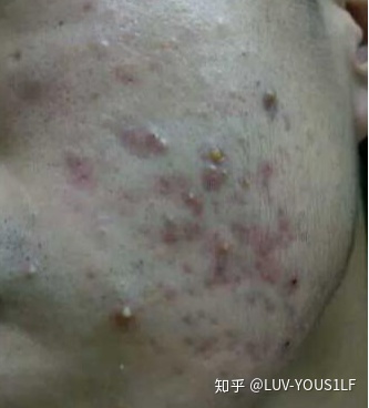 喜欢有痘痘的男生