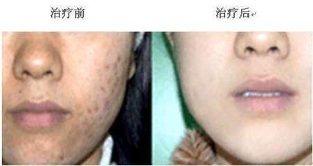 暗疮痘痘怎么治疗方法