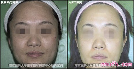 玻尿酸除皱效果能维持多久