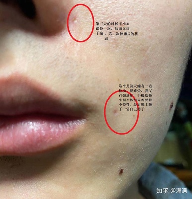 点痣以后怎么快速恢复