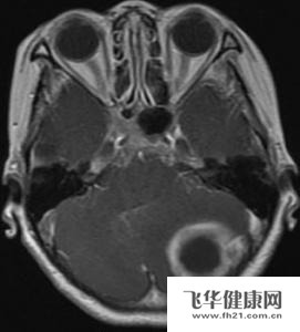 脑瘤怎么治疗最好