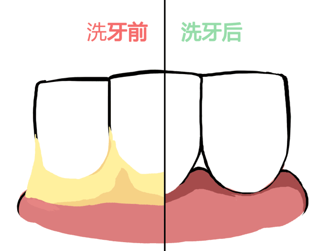 口腔贴面适应哪些牙