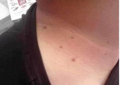 怎么去腋下的痘痘