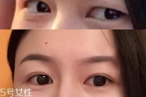 双眼皮什么时候贴