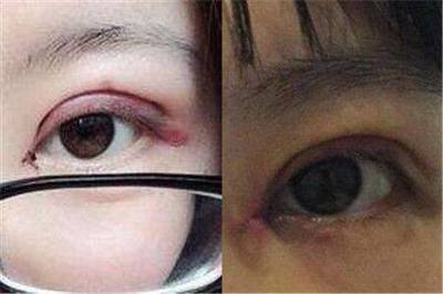 粘合双眼皮缺点