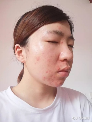 长痘痘变好的帖子