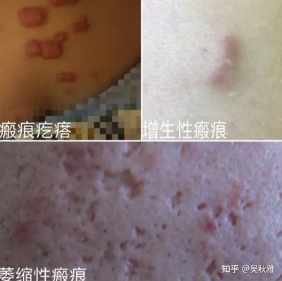 后青春期长痘痘怎么办