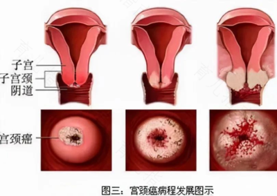 宫颈囊肿是怎么回事