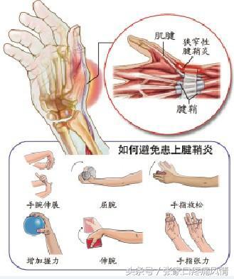 手关节腱鞘炎怎么治疗