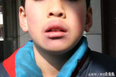 鼻子上生疮是怎么回事