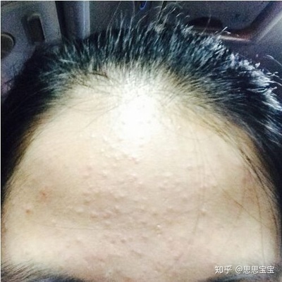 闭口痘痘粗糙