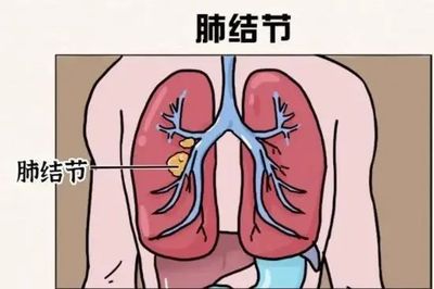 肺结节是怎么回事