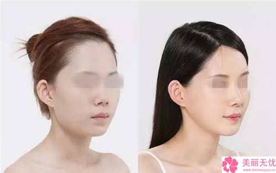 隆鼻7天后拆线疼不疼