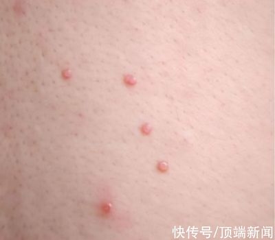 郑州 痘痘