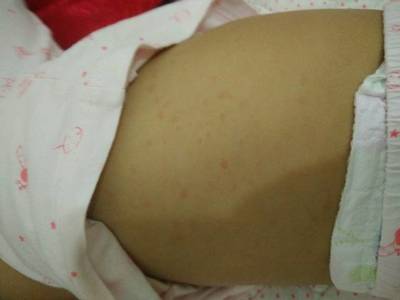宝宝39.1度怎么办
