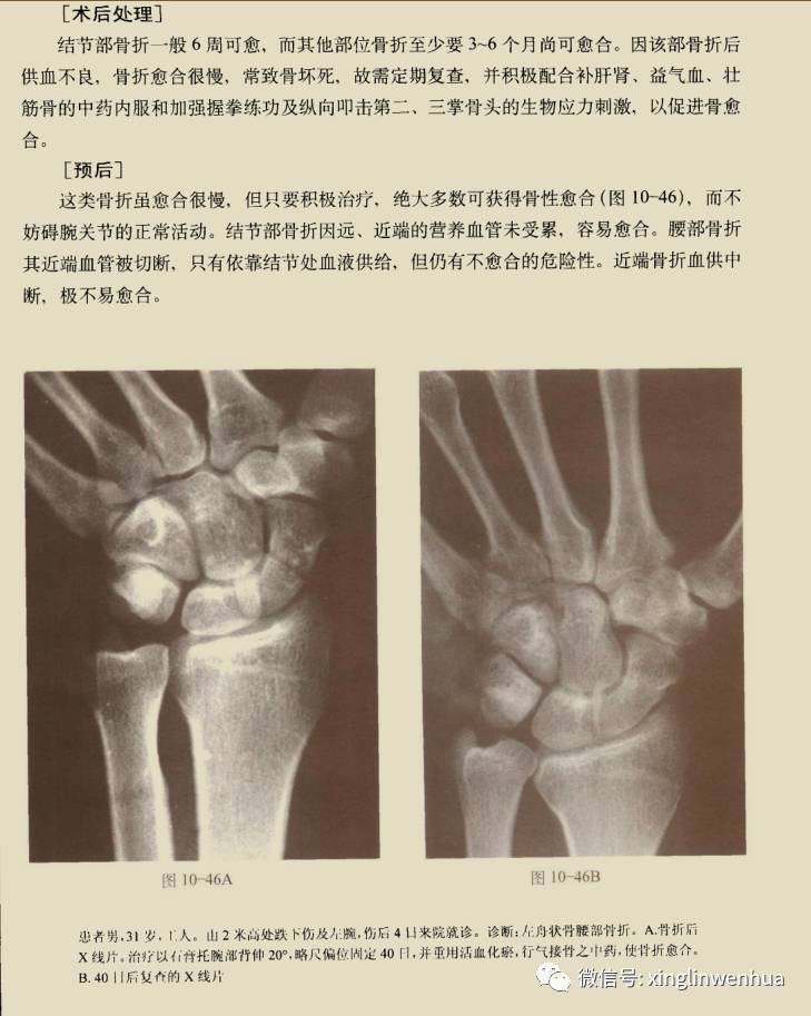 右手舟骨骨折能评几级伤残