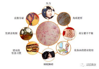 经常吃夜宵会长痘痘吗