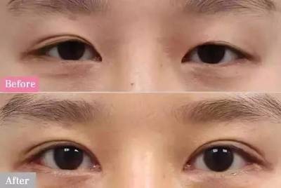 割完双眼皮想再开眼角