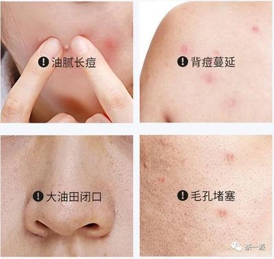 痘痘区域出油的原因