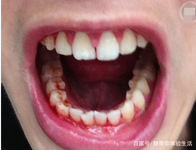 牙根出血是怎么回事