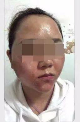脸上有痘痘能打水光针吗