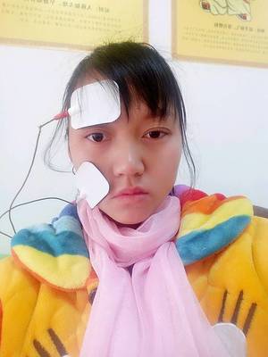 怀孕面瘫