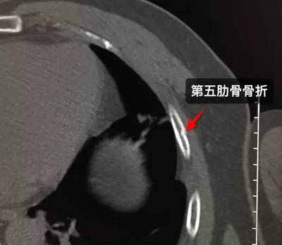 肋骨骨折拍ct多少钱