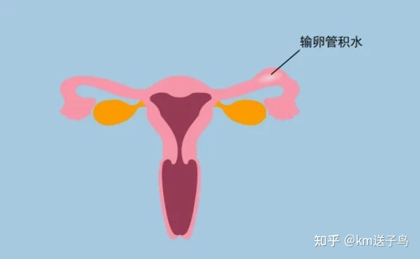 输卵管扩张是怎么回事