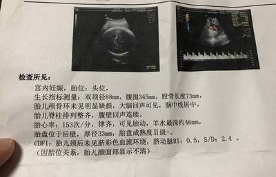 胎儿头位是入盆了吗