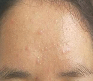 痘痘和粉刺啥区别