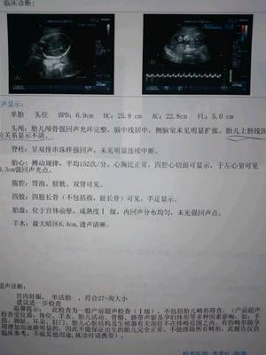 胎儿在左边