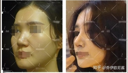 隆鼻等老了以后后遗症