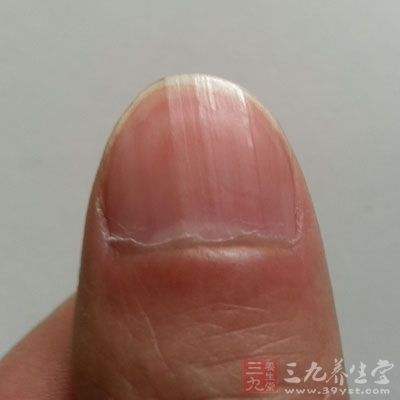 指甲出现竖条纹是怎么回事