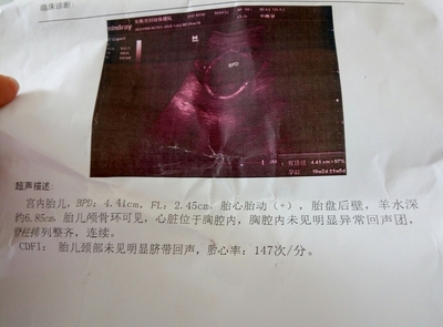 胎儿fl标准对照表