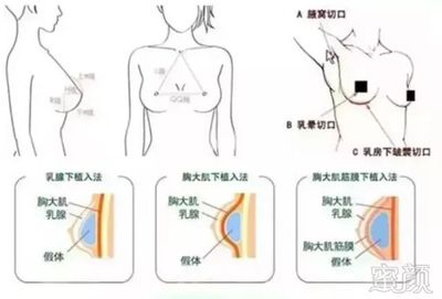 男人胸大手术多少钱