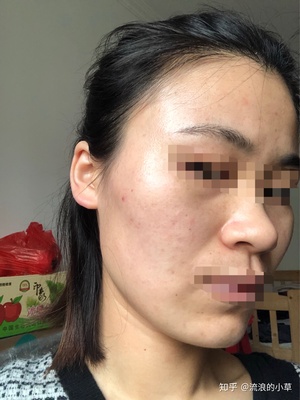 长痘痘吃什么会留痘印