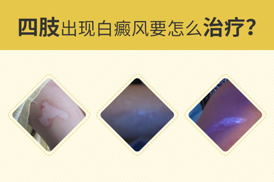 白癜风该怎么治疗好