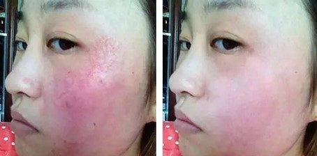 面部皮炎怎么治疗