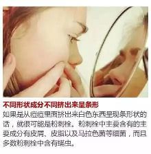 痘痘白白的要不要挤掉