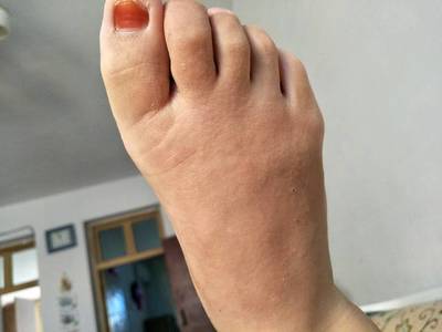 怀孕脚气怎么办