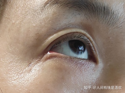 眼角老流泪是怎么回事