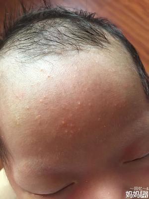 宝宝身上起痱子图片