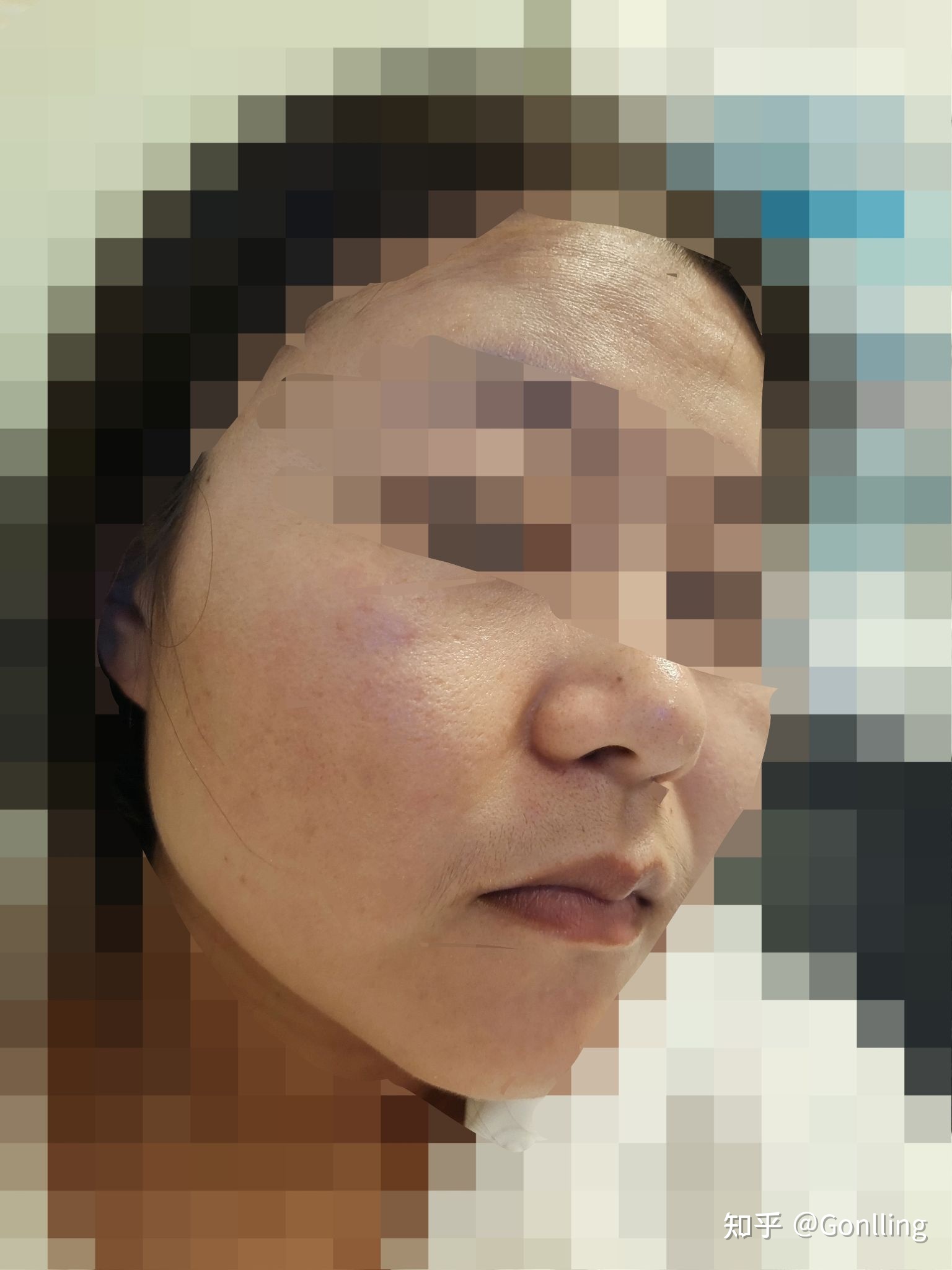 点痣后又长出来了怎么办