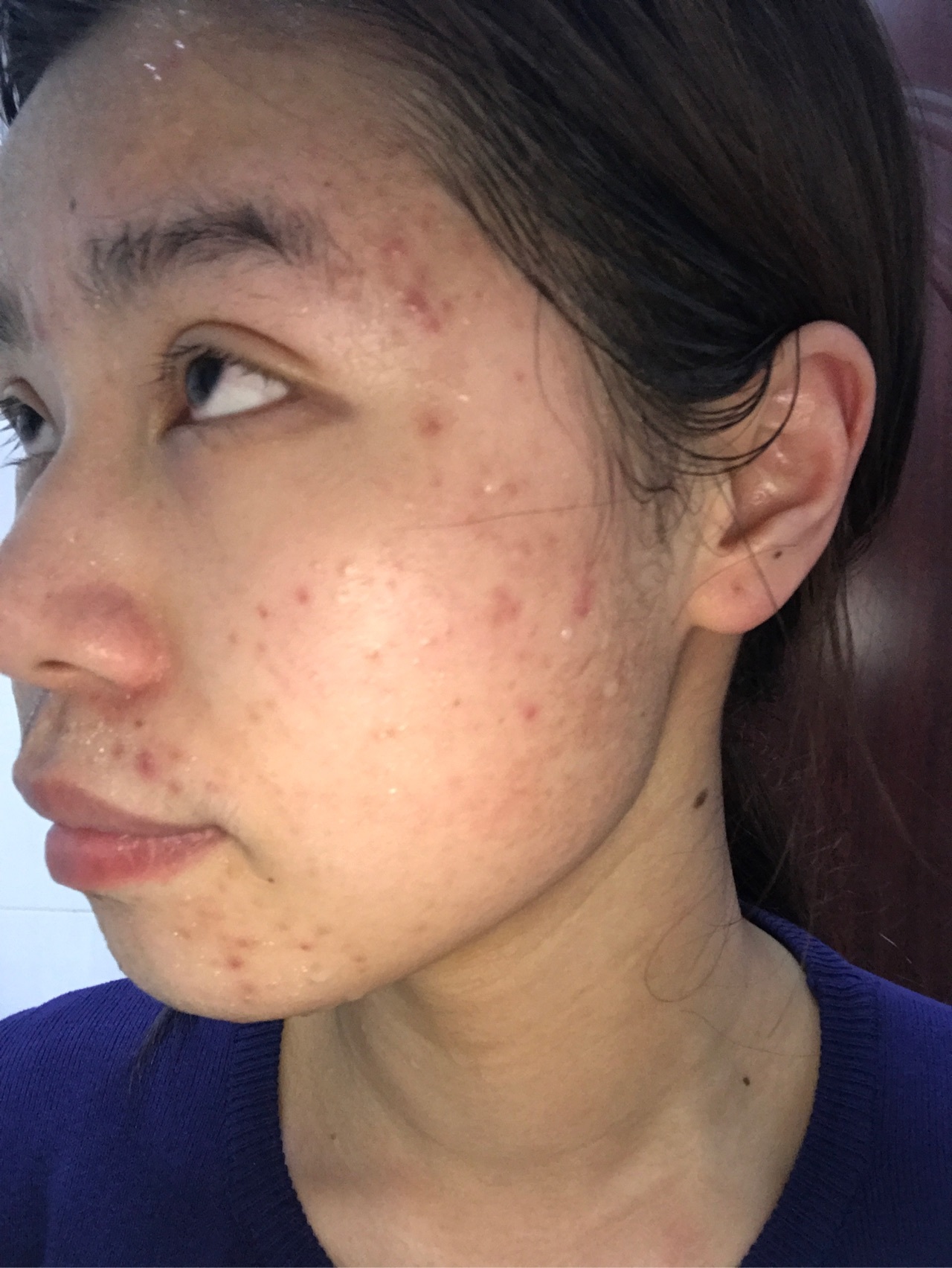 腮两边老长痘痘是什么原因