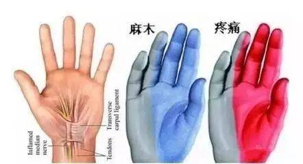 手抖手麻是怎么回事