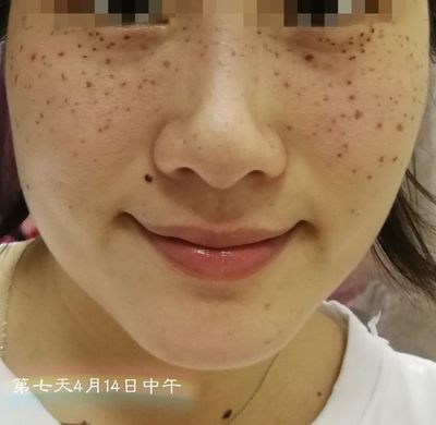 点痣以后怎么快速恢复
