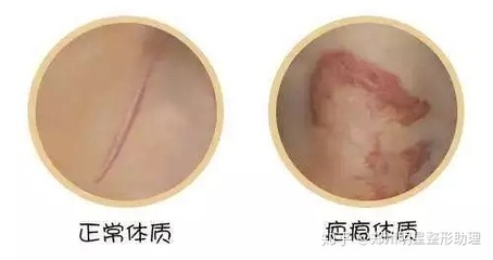 怎么判断自己是疤痕体质