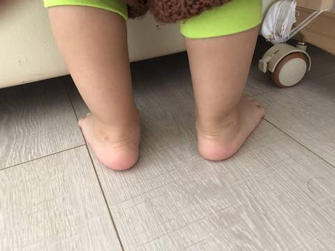 一岁半宝宝足外翻