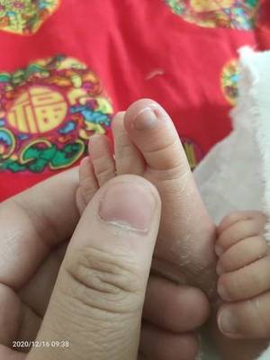 宝宝指甲根部皮肤发黑