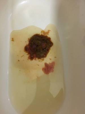 拉红色的屎是怎么回事